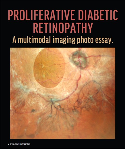 Oftalmoscópio de Varredura a Laser Mirante SLO/OCT & Mirante SLO