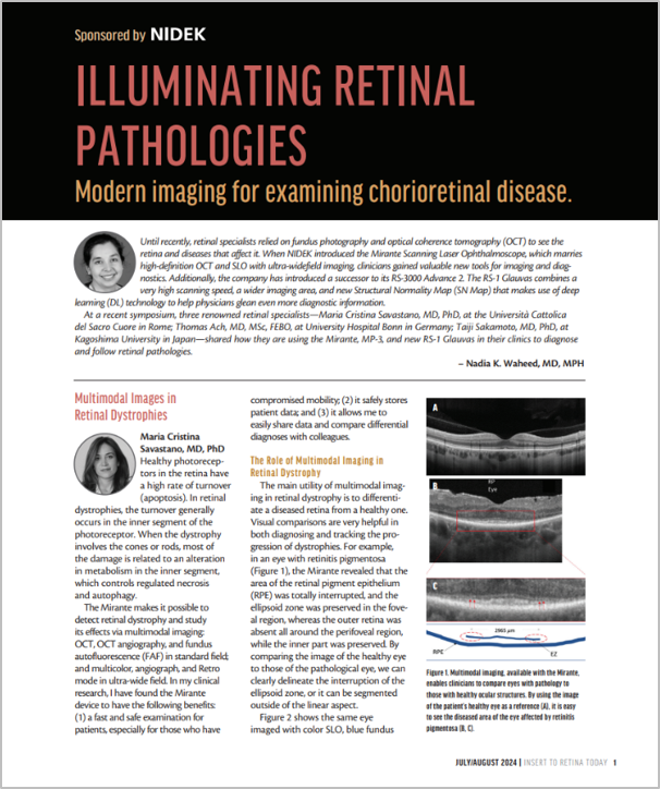Software para la Serie OCT de NIDEK – Base de Datos Normativa de Larga Longitud Axial