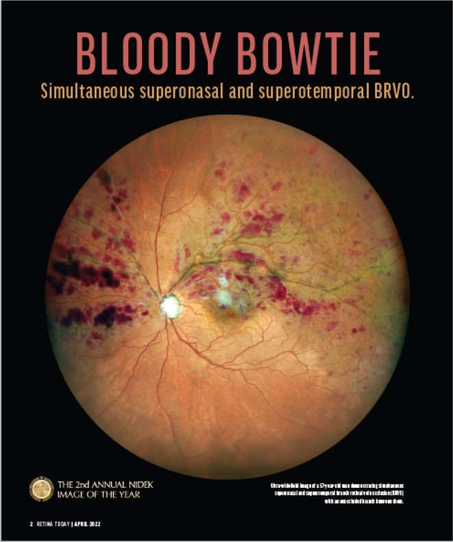 Oftalmoscópio de Varredura a Laser Mirante SLO/OCT & Mirante SLO