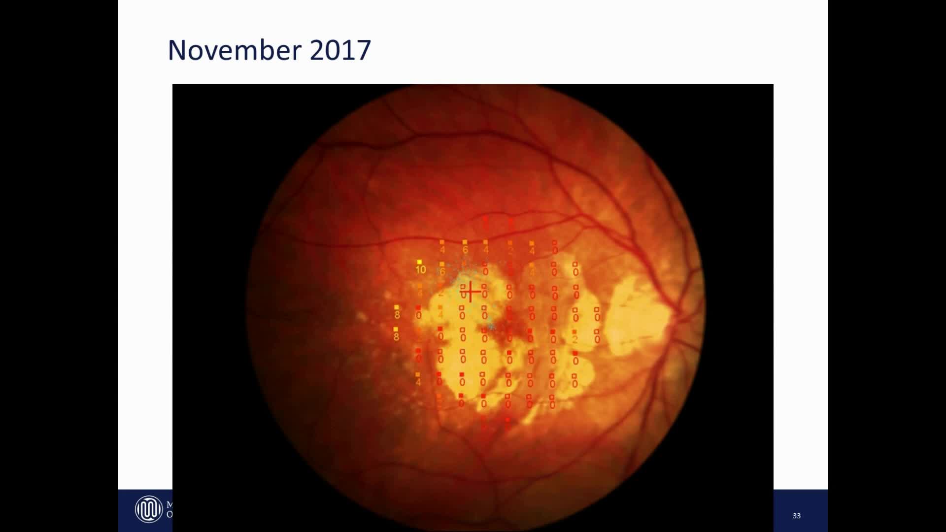 EURETINA 2018 (MP-3)